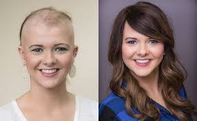 Jada Pinkett Smith sta mentendo sul fatto di avere l'alopecia. Ha una testa  piena di ciuffi di capelli tranne che su una sottile linea di cicatrice. La  vera alopecia è liscia e a