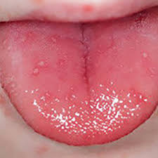 Hand Foot And Mouth Disease Warning As Children Hit By Wave Of Virus Mirror Online