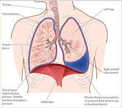 Diagnosis And Management Of Patients With Pleural Effusions