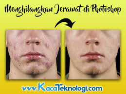 Jerawat adalah penyakit kulit yang bisa menyerang para wanita maupun pria. Cara Menghilangkan Jerawat Di Photoshop Hanya 3 Menit Kaca Teknologi