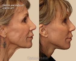 Before & afters of @teddimellencamp • She had surgery to tighten her  jawline and neck contour. We also did some Morpheus8 infused with a vitamin  cocktail to help with her skin texture.