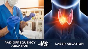 Image result for Radiofrequency Surgery