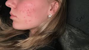 What are effective treatments for acne and skincare routines?