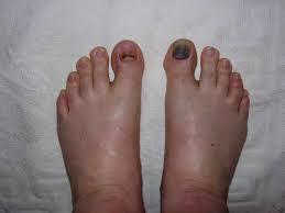 Image result for toe black diabetes