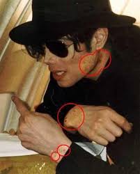 626 mil músicas, 53 milhões de pessoas cadastradas o maior site de. The Circles On This Photo Show What Was Left Of Michael S Original Skin Color Toward The End Of His Life The Vitiligo Michael Jackson Michael Jackson Jackson