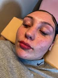 Hyaluronic pen lip filler in Mesquite TX