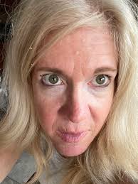 Sooo I Am at Bascom Palmer in Miami Having My Eyes Checked for 24 Pre  Cancer Spots. Left is Today, Right is 1yr Ago. Thankfully They Are Stable!  🌴💖🙏🙏🙏