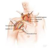 Image result for what is the treatment for brachial plexus injury video