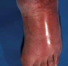 Describe and understand the mechanism of sepsis. Diagnosing And Managing Lower Limb Cellulitis Nursing Times