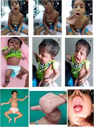 Recessive Vamp1 Mutations Associated With Severe Congenital Myasthenic Syndromes A Recognizable Clinical Phenotype European Journal Of Paediatric Neurology