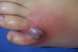 Image result for wolf spider bite skin