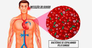 Um choque séptico pode causar síndrome de disfunção multiorgânica , anteriormente conhecido como falência de vários órgãos e morte. Septicemia O Que E Sintomas E Tratamento Tua Saude