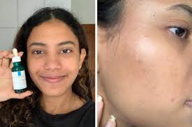 Check spelling or type a new query. 5 Girls Tried La Roche Posay S Effaclar Serum To See If They Could Get Smooth Clear Even Skin After 1 Month Zula Sg