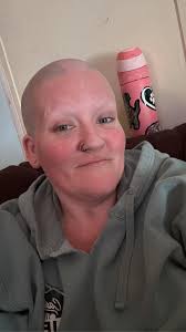 Hair styles for hair loss