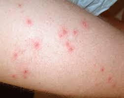 The rash may appear 12 hours to 2 days following exposure, typically itches, and usually resolves Pseudomonas Skin Infection Hot Tub
