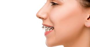 An overbite is a common dental condition. How Do Braces Fix Overbites Premier Orthodontics