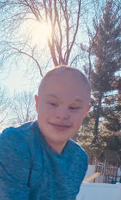 20 Sunshine Syndrome