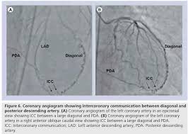 We can calculate the number of elements in the corresponding diagonal by doing some math but we can. Open Ended Coronary Circulation Innocent Bystander Or A Road Map For Intervention