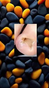 Effective Toenail Removal for Ingrown Toenails