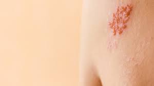 Gurtelrose Herpes Zoster Ursachen Symptome Und Behandlung Lz Gesundheitsreport