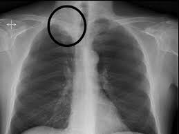 Kol Damarinda Pihti Olusmasi Ve Kol Agrisi Doktor Fizik