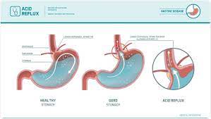 Japanese gastric cancer association 2011. Causes Of Heartburn Acid Reflux