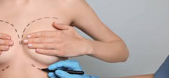 Ultimate Guide to Breast Augmentation: What You Should Know