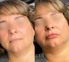 Nurse Melissa|Botox•Filler Fat Dissolving•Natural Results  (@melissa.freezefillglow) • Instagram photos and videos
