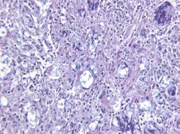Recessed lighting installation necrotizing granulomatous inflammation. Pathology Of Sarcoidosis And Differential Diagnostics Of Other Granulomatous Diseases Intechopen