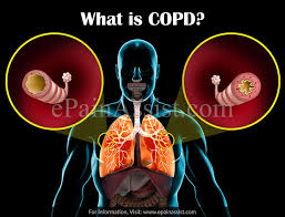 As copd research continues, medical scientists are developing tables and mortality models that help them determine life expectancy related to both the disease and complicating factors—most notably smoking. Copd Causes Signs Symptoms Treatments Stages Life Expectancy Surgery Home Treatment