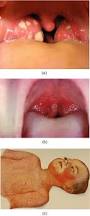 Image result for Strep throat infection roof of mouth