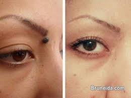 Tahi lalat terbentuk dari sel penghasil zat warna atau pigmen kulit tahi lalat bukanlah suatu penyakit yang menimbulkan gejala tertentu. Ubat Menghilangkan Tahi Lalat Butir Skintag Biji Kolestrol Health Beauty For Sale In Brunei Muara Bruneida Com Mobile 7788