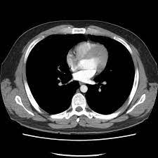 We are providing the best quality of it. Normal Ct Chest Radiology Case Radiopaedia Org