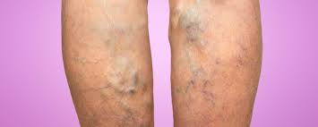 Varicose veins appear most often in the legs. Five Myths About Spider And Varicose Veins Mercyone Iowa Heart Vein Center
