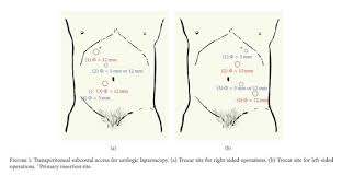 Therefore, one is expected to find an adherent omentum, stomach, and even liver or enlarged spleen at this site. Transperitoneal Subcostal Access For Urologic Laparoscopy Experience Of A Large Chinese Center Document Gale Academic Onefile