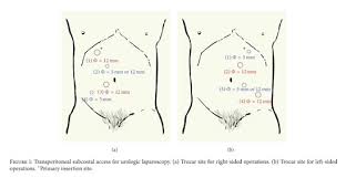 In almost three fourths of cases, the indications for. Transperitoneal Subcostal Access For Urologic Laparoscopy Experience Of A Large Chinese Center Document Gale Academic Onefile