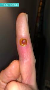 Image result for Pyogenic Granuloma