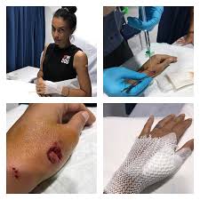 Maybe you would like to learn more about one of these? Tangan Sophia Latjuba Berdarah Darah Digigit Anjing Liar