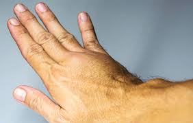 Blood clot signs and symptoms as well as your risk for blood clots and ways to prevent blood clots. 6 Signs Of A Blood Clot Men S Health