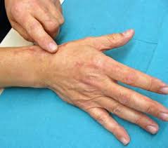 Daumen Sattelgelenksarthrose Rhizarthrose Dsg Arthrose Handerkrankungen