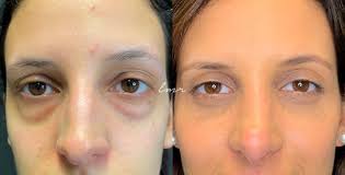 Blefaroplastia Superior E Inferior Cirurgia Das Palpebras 18757 2