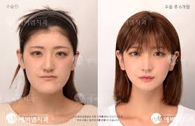 面長さよなら 鼻下から短く エバーエムの童顔手術 korean beauty support韓国美容整形ブログ 輪郭手術 両顎手術 美容整形 童顔 若返り