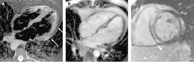 Sie kann akut oder chronisch verlaufen. Serial Late Gadolinium Enhanced Cardiac Mri Scans Of The Patient With Download Scientific Diagram