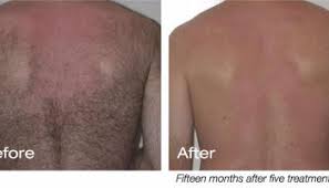 What are laser hair removal treatments like? Cost Of Laser Hair Removal Strayhair