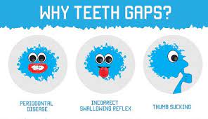 How to fix a small gap in your teeth. How To Fix Gap In Front Teeth Without Braces