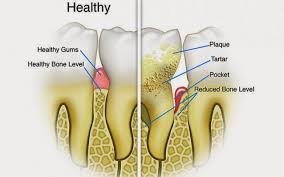 What are some home remedies for removing tooth tartar? Home Remedies To Remove Tartar And Plaque Build Up On Teeth Mybetterdentists