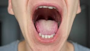 Image result for white cancer on tongue)
