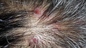 Image result for white scabs on the head in children
