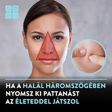 Dr. Mark Storm New York-i bőrgyógyász mesélt az úgynevezett halál  háromszögről.😱 Vannak olyan területek az arcunkon, ahol egyenesen tilos  nekiesni pattanásoknak, ugyanis akár halálos szövődményt is  kockáztathatunk❗️