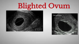 What to do with a blighted ovum pregnancy? Blighted Ovum Copy1 By Edith617 On Emaze